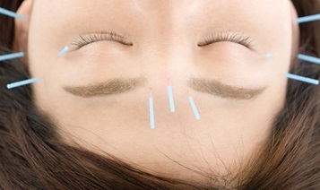 目の周りに存在するツボに鍼をする事で目の循環を促し眼精疲労など辛い目の症状に対応します（ぴりか治療院）